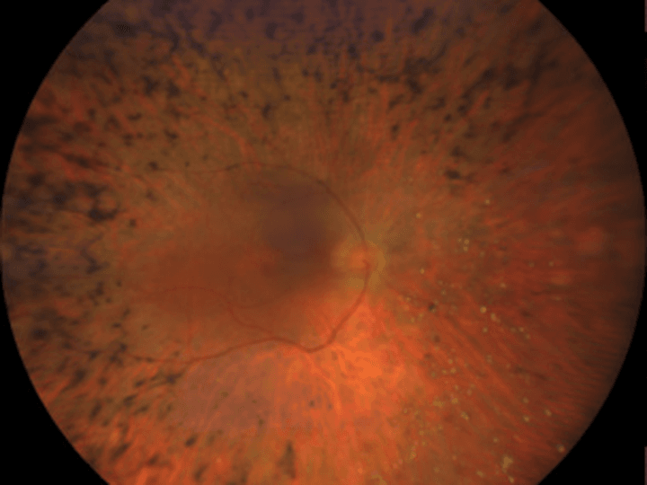 Retinosis pigmentaria