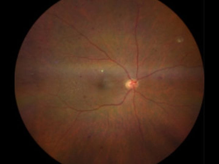 Retinopatía Diabética: Protegiendo tu Visión. Guía Completa de 5 Preguntas Esenciales